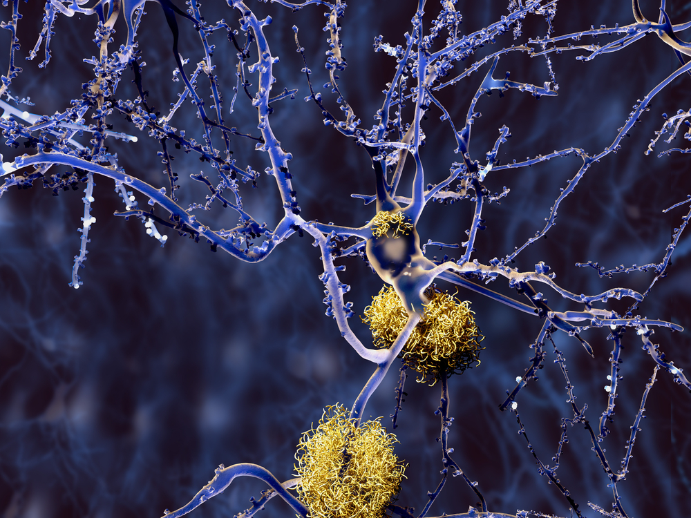 imagen del articulo Alzheimer: investigan una nueva muerte con el uso de lecanemab